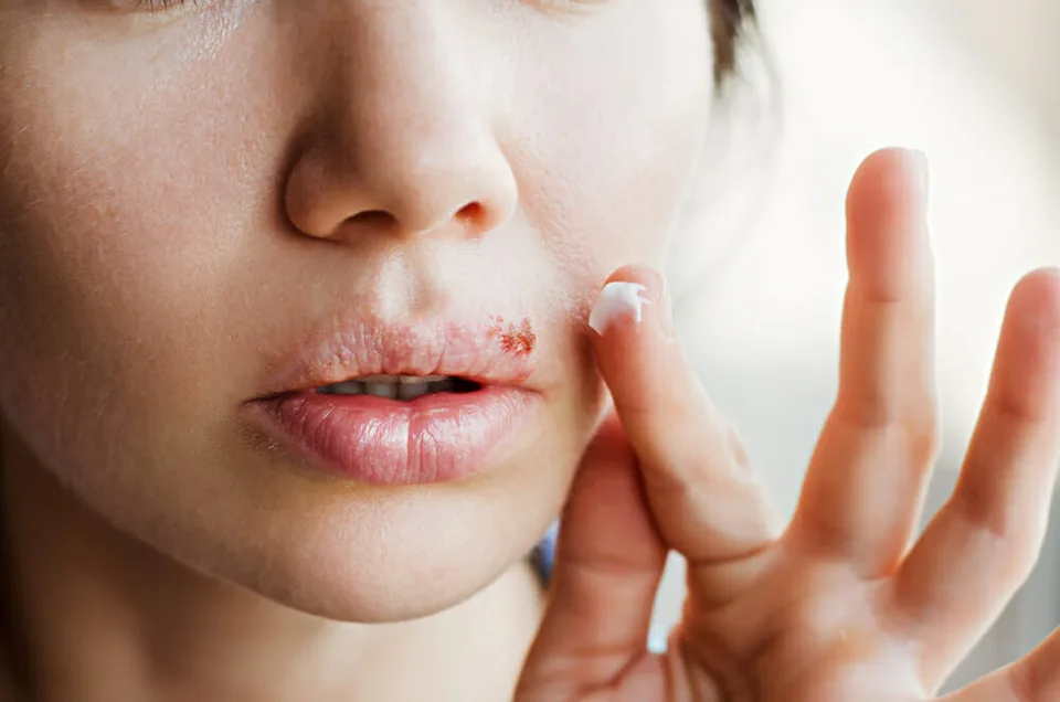 Read more about the article ŠÚKL informuje o stiahnutí lieku na herpes z trhu