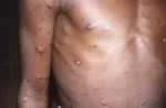 Na snímke z roku 1997 je pravá ruka a trup pacienta s opičími kiahňami.