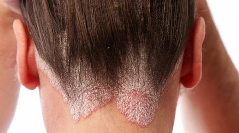 Read more about the article Na vzniku psoriázy sa podieľa genetika, stres aj životný štýl
